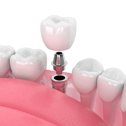 dental-implants